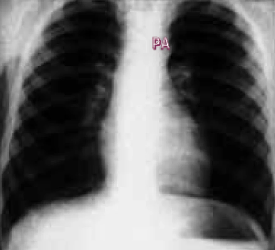Skiagram Fallotovy tetralogie ukazuje normální vzhled kromě lehce prominující aorty.
