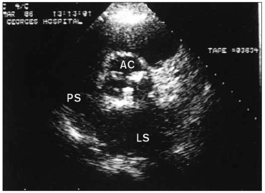 Parasternální sekce krátké osy u pacienta s revmatickou stenózou aorty. Kalcifikace ve fúzovaných komisurách trojcípé aortální chlopně.