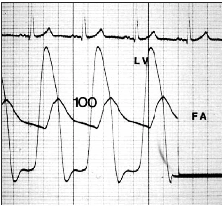 Tlakový záznam ukazuje gradient přes aortální chlopeň.