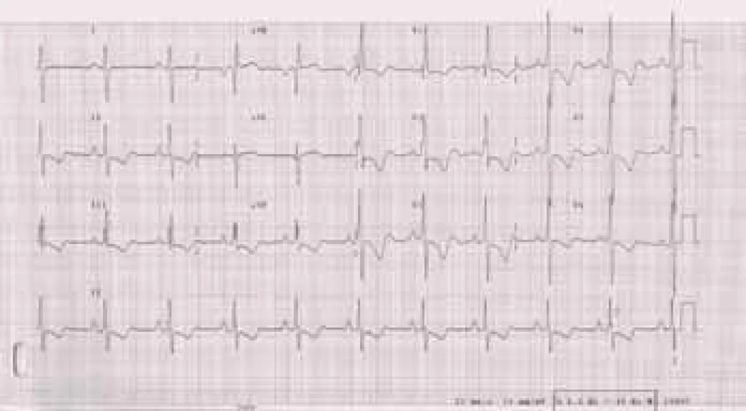 EKG u nemocné s těžkou plicní arteriální hypertenzí: P pulmonale. R/S ve V1 &gt; 1, inkompletní blokáda pravého raménka Tawarova, naznačené deprese ST a negativní T ve svodech II, III, aVF, V1-6.