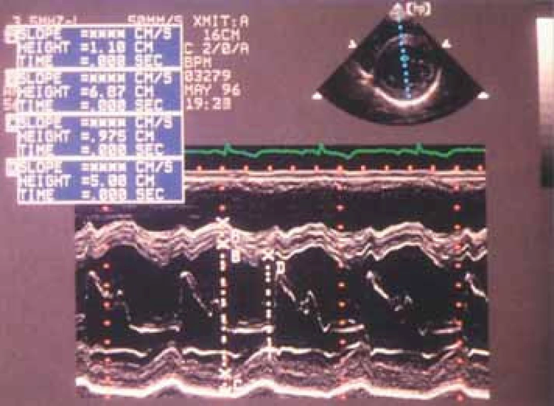Záznam M-modu v sekci parasternální krátké osy levé komory u případu těžké aortální regurgitace. Komora je zvětšená a kontrakce hyperdynamická s frakčním zkrácením 45 %.