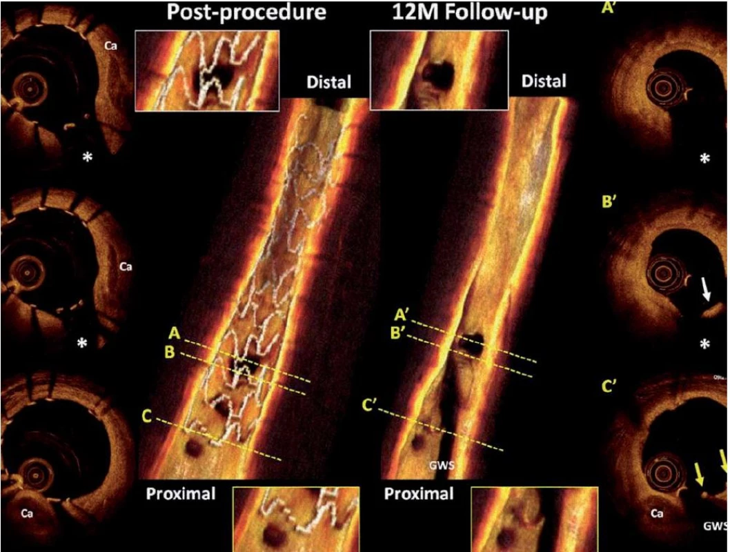 Optická koherentní tomografie časně po implantaci a v jednoročním odstupu, vstřebatelný stent Absorb BVS (Abbott Vascular, CA, USA).