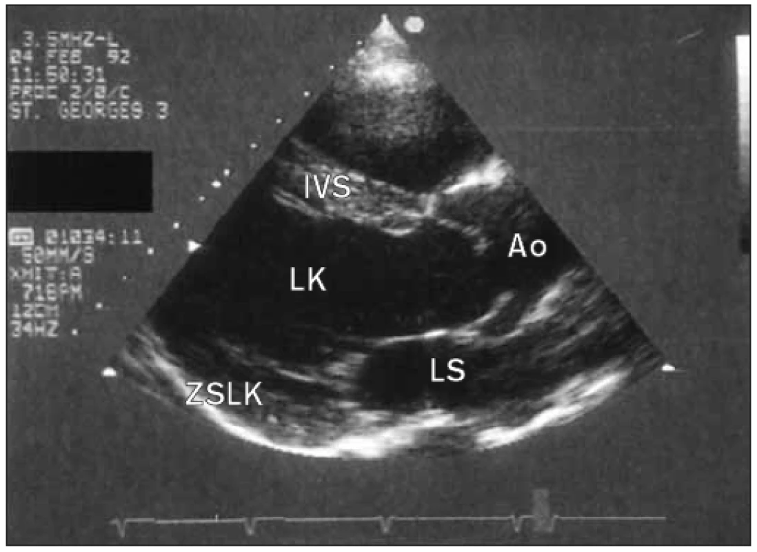 Parasternální pohled v dlouhé ose u pacienta s kongenitální bikuspidální chlopní aorty. Cípy jsou lehce ztluštělé a ukazují charakteristické vyklenutí v systole. Lehké rozšíření proximální vzestupné aorty.