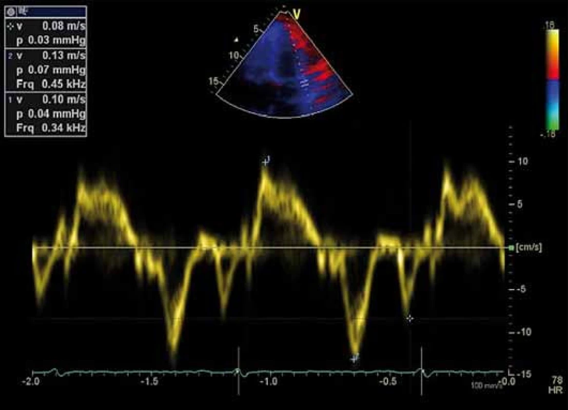 Záznam pohybu mitrálního anulu tkáňovou dopplerovskou echokardiografií, fyziologický nález.