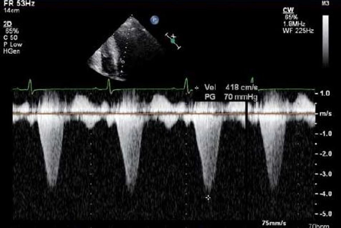 Kontinuální dopplerovký záznam z výtokového traktu u pacienta s hypertrofickou kardiomyopatií a obstrukcí.