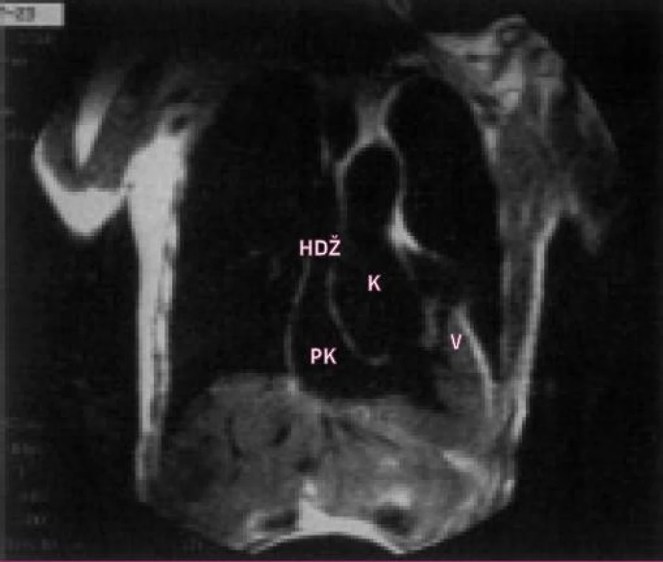 Obraz spin echa v koronální rovině u 70letého pacienta se stenózou plicnice jako součásti nekorigované Fallotovy tetralogie. Pravá komora je hypertrofická, infundibulum je zúženo a ztluštěno, s poststenotickou dilatací kmene plicnice. Dilatovaný aortální kořen.