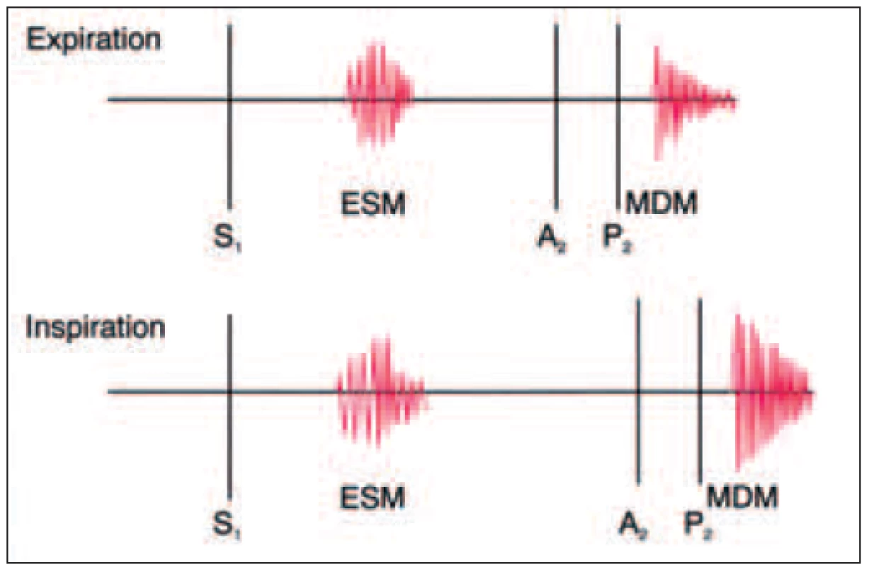 Auskultační nálezy defektu septa síní jsou charakterizovány relativně fixovaným rozštěpem druhé srdeční ozvy během inspirace i exspirace, ejekčním systolickým šelestem nad levým mezižebřím vlivem zvýšeného průtoku. Aortální a pulmonální komponenty druhé ozvy jsou stejnoměrně odloženy během inspirace vlivem fixního rozštěpu. Při velkém zkratu může být trikuspidální průtokový šelest slyšet podél levého kraje dolního sterna.
