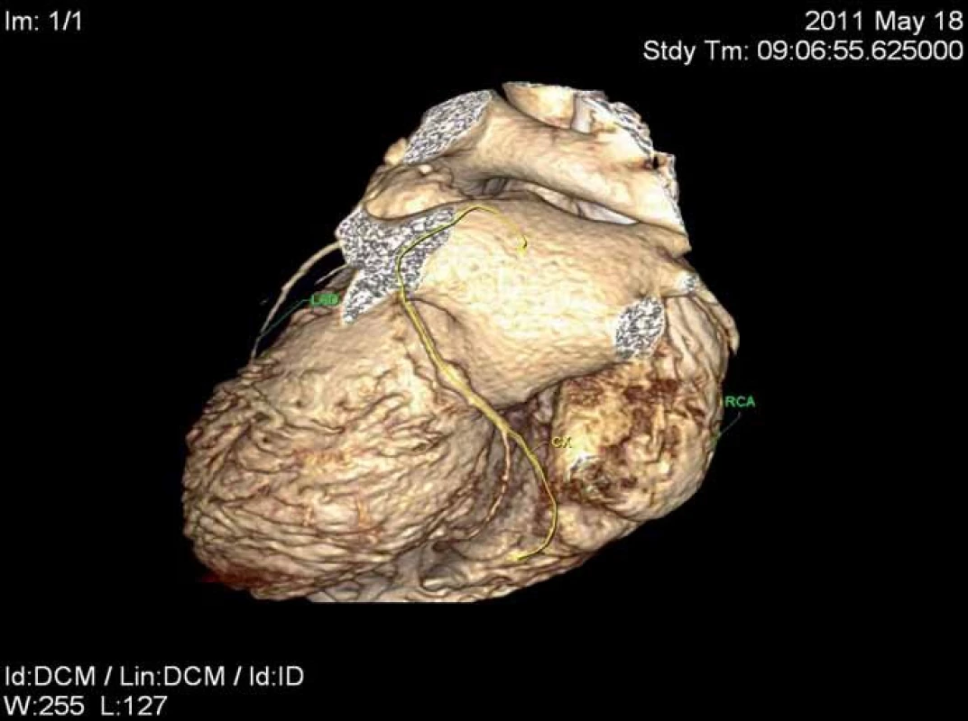Obraz aneuryzmatu na ramus cirkumflexus (RCx) z CT koronarografie.