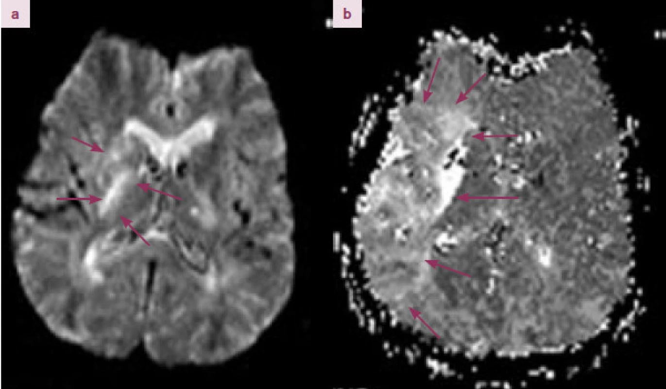 MRI DWI/ PWI mismatch. 74letá pacientka s uzávěrem a. cerebri media vlevo. Dle MRI difuze (MRI DWI) patrná porucha difuze vlevo v oblasti bazálních ganglií a kapsula interna (a). Na MRI perfuzi (MRI PWI) se zobrazuje hypoperfundované pole v povodí ACM v rozsahu cca 10 × 4 cm. Rozdíl plochy DWI a PWI (DWI/ PWI mismatch) je větší než 20 %.