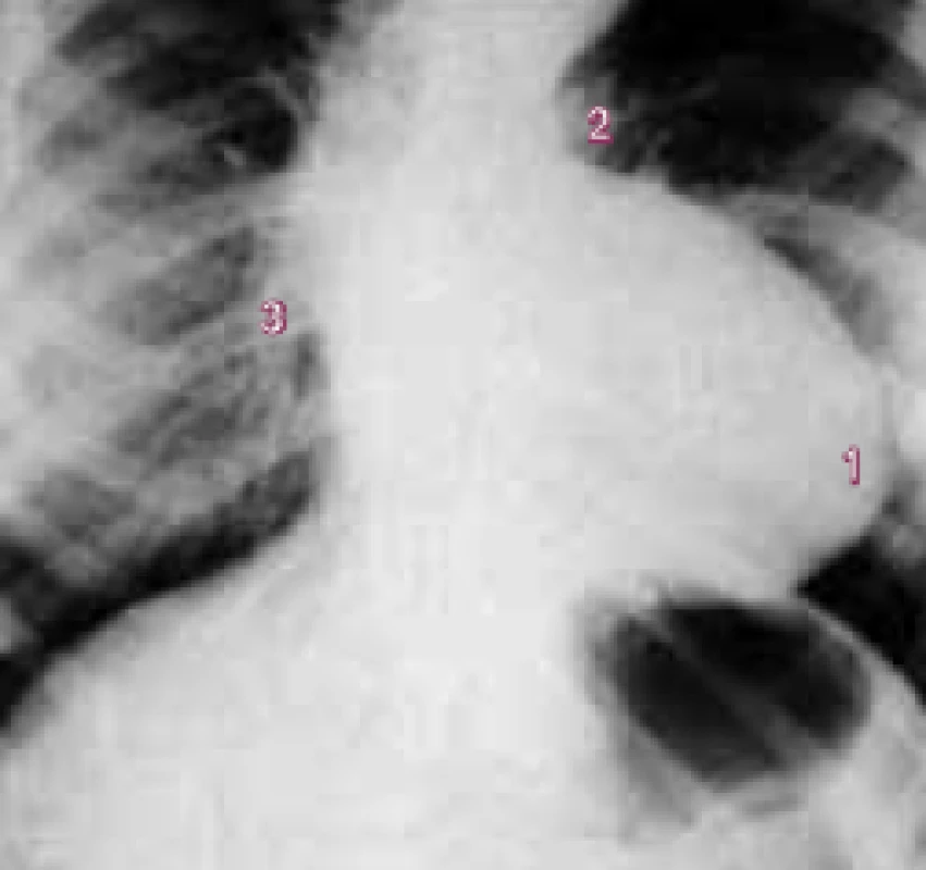 Skiagram Fallotovy tetralogie ukazuje typickou srdeční siluetu způsobenou (1) zdviženým hrotem, (2) výrazným pulmonálním zářezem způsobeným malou plicní tepnou, a (3) sníženou náplní plicního řečitě.
