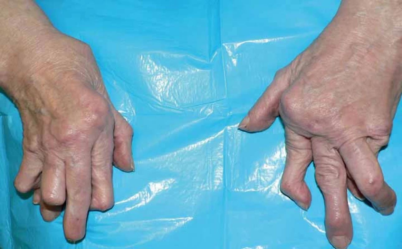 Typický vzhled ruky u destruktivní revmatoidní artritidy.