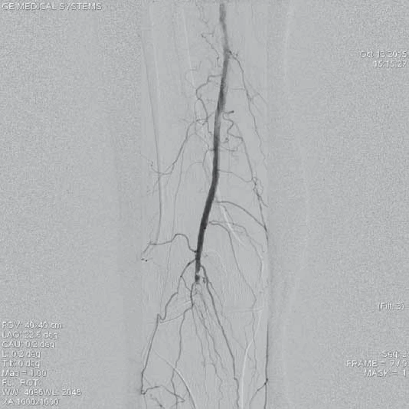 Aterotrombotický uzávěr popliteální arterie vpravo.