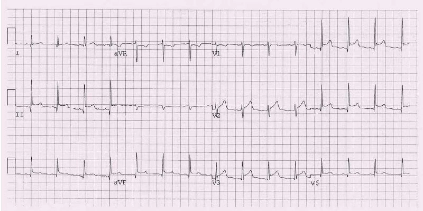 EKG u perikarditidy (konkávní elevace ST úseku ve svodech II, III a VF, V3).