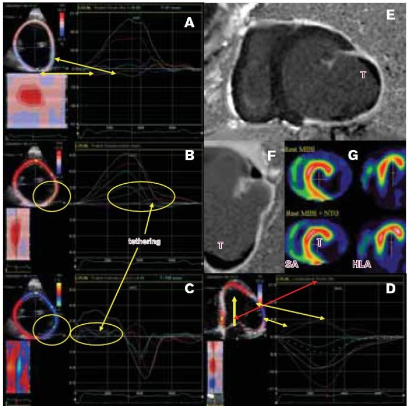 Vybrané spektrální křivky speckle tracking echokardiografie.
A. Cirkumferenciální (obvodový) strain (ε) vyjadřující míru deformace dané oblasti zájmu hodnocený v parasternální projekci v úrovni srdečního hrotu u zdravého jedince s nálezem kvantitativně a kvalitativně normální systolické deformace s maximem v časovém horizontu uzávěru aortální chlopně (aortic valve closure - AVC)- εsyst. Vlevo nahoře je B-mode uvedené projekce se superponovaným obrazem speckle tracking echokardiografie v parametru cirkumferenciální ε (%). Celá levá komora je rozdělena do 6 segmentů, které představují regiony zájmu, pro které jsou sumárně hodnoceny jednotlivé parametry. Vlevo dole je v C-mode (curved mode) levá komora rozprostřena, jednotlivé segmenty jsou opět označeny identicky barevně a je evidentní distribuce parametru cirkumferenciálního ε v průběhu srdečního cyklu. Vpravo je graficky patrný spektrální průběh křivek jednotlivých segmentů pro parametr cirkumferenciální ε, ze kterých je možná jejich přesná kvantitativní analýza a měření časových intervalů. Tečkovaná čára znázorňuje vypočítanou průměrnou hodnotu daného parametru sumárně pro vyšetřenou echokardiografickou projekci.
B. Radiální ε hodnocený v parasternální projekci v úrovni mitrální chlopně u jiného subjektu s nálezem kvantitativně a kvalitativně normální systolické deformace s maximem v časovém horizontu těsně po uzávěru aortální chlopně (AVC), kromě anterobazálního segmentu (žlutá).
C. Radiální strain rate (SR) vyjadřující rychlost deformace (s-1) hodnocený v parasternální projekci v úrovni srdečního hrotu u zdravého jedince s nálezem kvantitativně normální SR s maximem v časovém horizontu uzávěru aortální chlopně (AVC) s lehce nehomogenní distribucí maximálních endsystolických hodnot SR, ale v kvantitativních mezích normy. Hodnoty SRe a SRa vyjadřují jednotlivé diastolické komponenty daného parametru.
D, E, F. Hodnocení rotace a torze LK. Během systoly je v projekci na krátkou osu LK v úrovni srdečního hrotu patrná lehce negativní (clockwise) časná systolická (ve fázi izovolumické kontrakce - žlutá šipka) a dominantní pozdně systolická (bílá šipka) rotace apexu proti směru hodinových ručiček (counterclockwise) a opačná orientace rotace v úrovni papilárních svalů a srdeční baze. Rotace (°) je hodnocená pro jednotlivé segmenty (barevné spektrální křivky) a sumárně pro danou projekci (tečkovaná křivka).