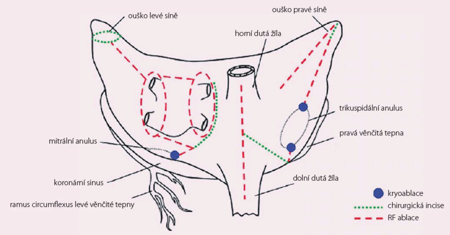 Schéma procedury Cox-MAZE IV.