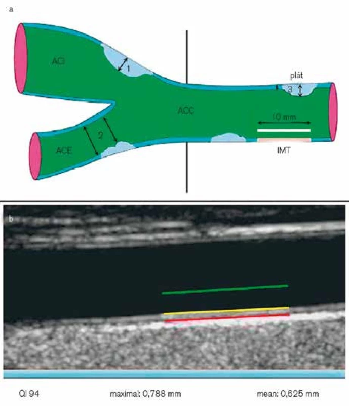 Tloušťka stěny karotidy (IMT) je ultrazuvokovým přístrojem automaticky měřena v 10 mm dlouhém úseku na zadní straně arteria carotis communis (ACC) před bifurkací na a. carotis interna (ACI) a a. carotis externa (ACE) (a – místo měření IMT vyznačeno růžově; b – ze 150 automatických měření mezi žlutou a červenou linií je vypočítána průměrná hodnota IMT). Za aterosklerotický plát jsou dle mezinárodního konsenzu považována místa, kde je cévní stěna širší &gt; 1,5 mm (b-1), zužuje lumen o &gt; 0,5 mm (b-2) nebo se IMT oproti okolním místům rozšiřuje o &gt; 50 % (b-3), upraveno dle [18].