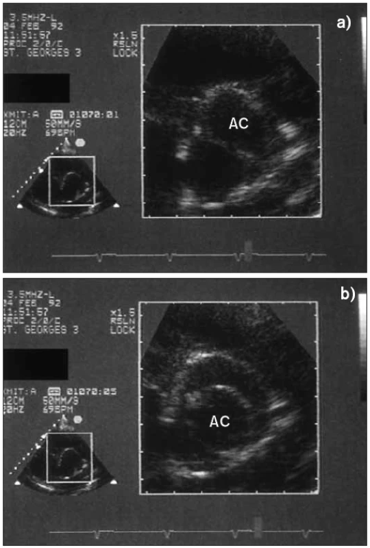 Pohled v parasternální krátké ose u pacienta s bikuspidální chlopní aorty (a) ukazuje v diastole diagonální linii uzávěru a (b) v systole otevřené chlopňové ústí spíše tvaru „citronu“ než trojúhelníku.