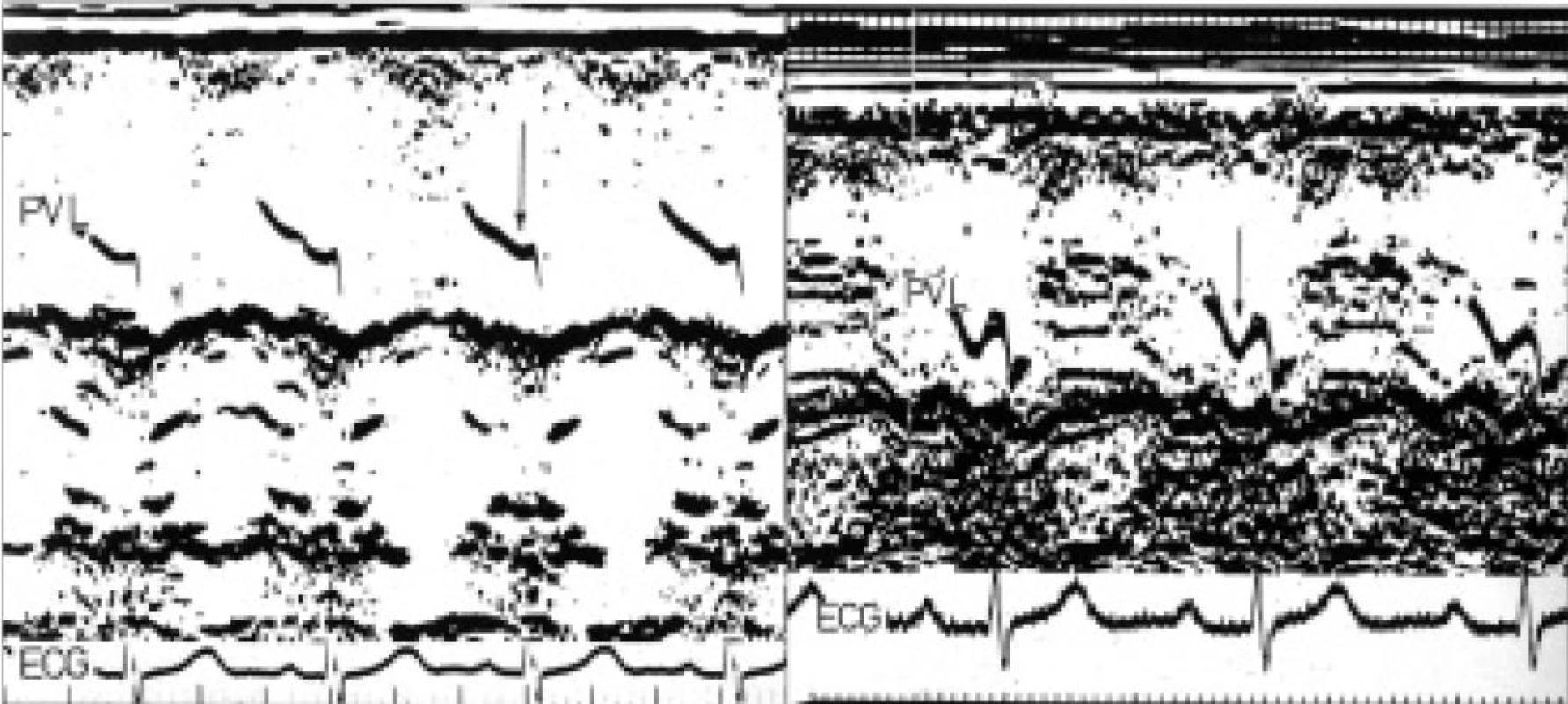 M-mode chlopně plicnice ukazuje normální sestupný dip (šipka na levém panelu) v síňové systole. Na pravém panelu je dip výrazný (šipka) a poukazuje na přítomnost široké vlny „a“ pravé komory u pacienta s těžkou stenózou plicnice.