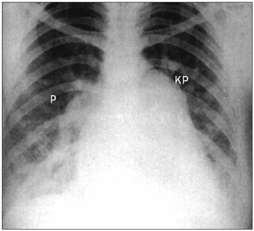 Skiagram atriálního defektu septa síní s plicní hypertenzí, velkým srdečním stínem a značně dilatovaným kmenem plicnice a výraznou pletorou.