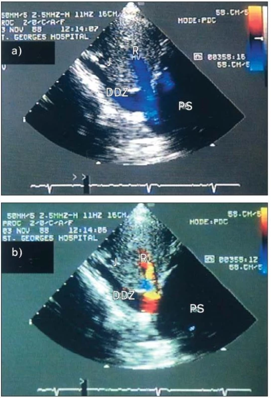 U těžké trikuspidální regurgitace může být barevné dopplerovské vyšetření použit k průkazu systolického refluxu do jaterních žil. a) Diastolický snímek ukazuje tok krve od měniče (modře), neboť směřuje od jater do dolní duté žíly (DDŽ). b) Systolický snímek ukazuje tok k měniči (červeně) od DDŽ do širokých jaterních žil.