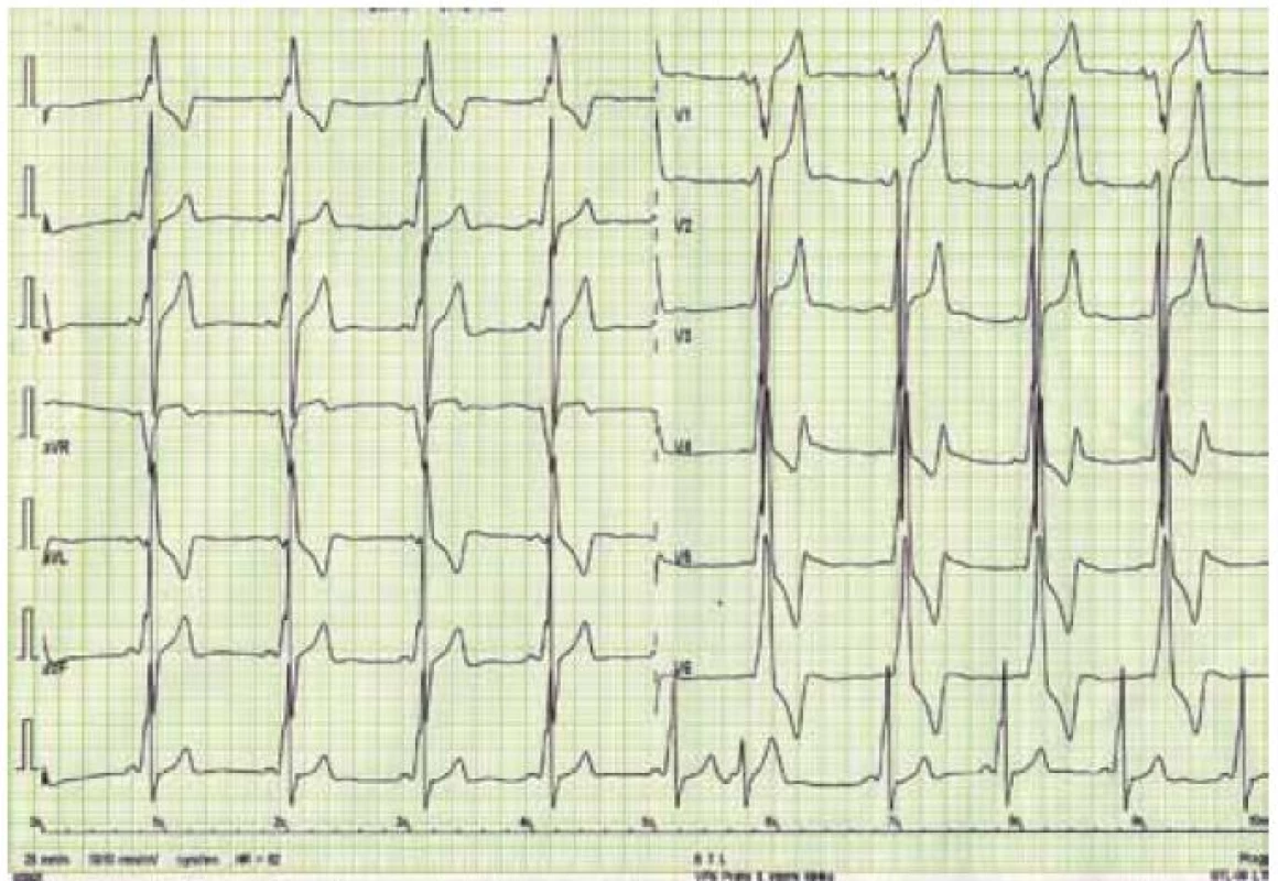 Elektrokardiogram nemocného s Danonovou chorobou – obraz preexcitace se zkrácením PQ intervalu a přítomností delta vlny společně s voltážovými kritérii hypertrofie levé komory a doprovodnými repolarizačními změnami.