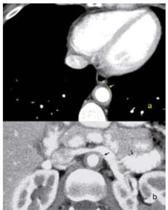 CT obraz zesílení stěny aorty při aortitidě. a – hrudní aorta, b – břišní aorta.
