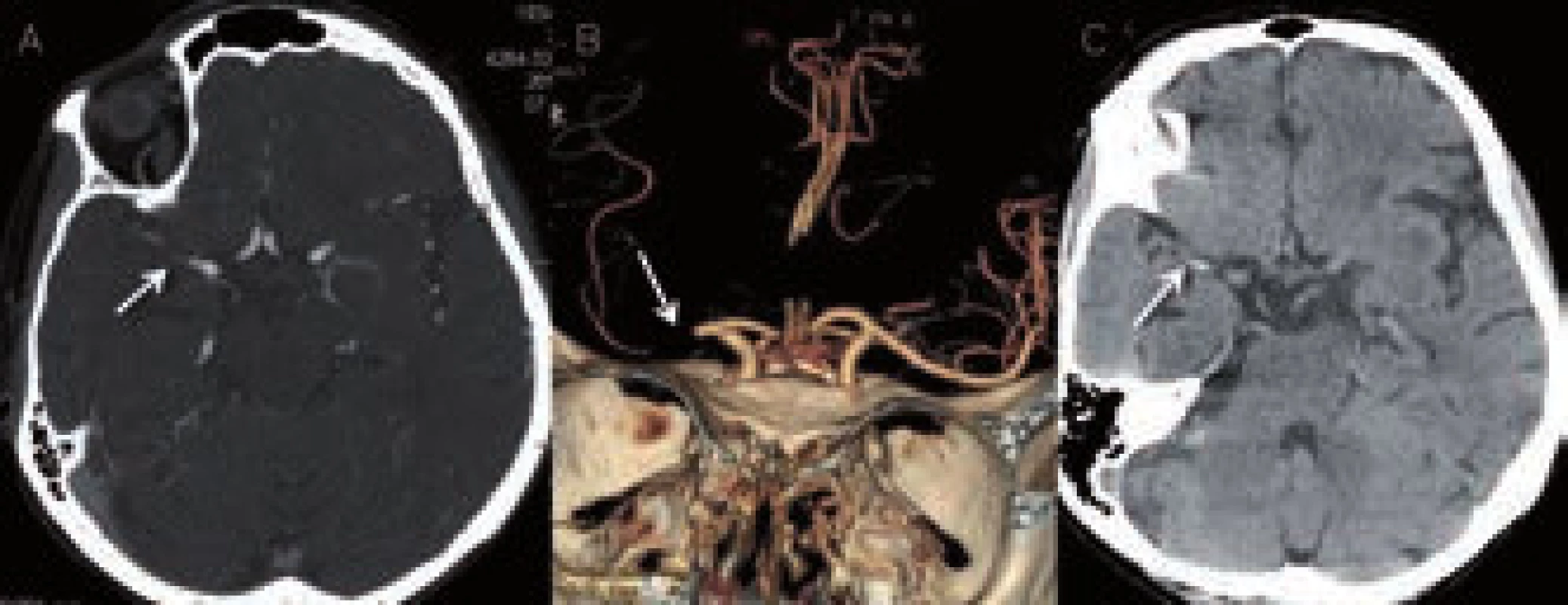 Pacientka s okluzí M1 úseku ACM vpravo. Na obr. A a B je zdrojový snímek a rekonstrukce CT angiografie. C – nativní snímek s nálezem dense artery sign v odpovídající lokalizaci.