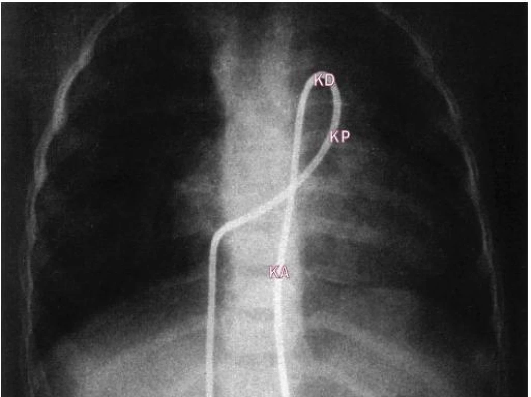 Skiagram typické pozice srdečního katétru procházejícího dučejí z plicnice do sestupné aorty.