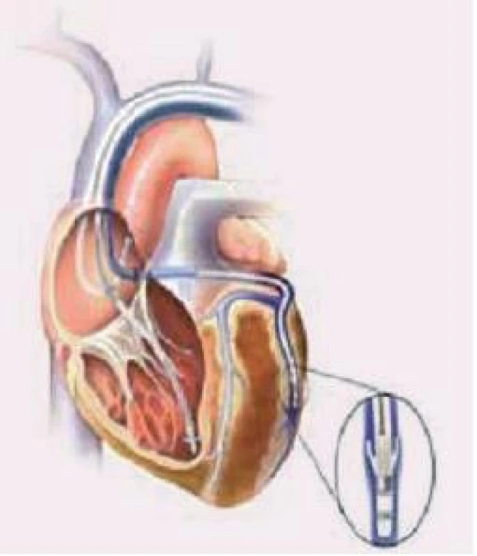 Zavedení elektrod při implantaci biventrikulárního kardiostimulátoru.