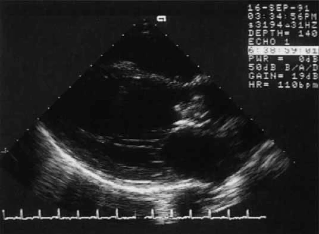 Parasternální pohled v dlouhé ose u těžké aortální regurgitace při infekční endokarditidě. Velká nepravidelně tvarovaná masa vegetací během diastoly prolabuje do levého výtokového traktu.
