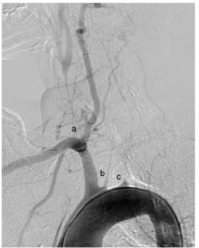 Angiografický obrázek Takayasu arteritidy v chronickém stadiu s obliteracemi magistrálních mozkových tepen. Mozek je zásobován jedinou mohutnou vertebrální tepnou. a – obliterace pravé společné karotidy, b – obliterace levé společné karotidy, c – obliterace levostranné podklíčkové tepny.