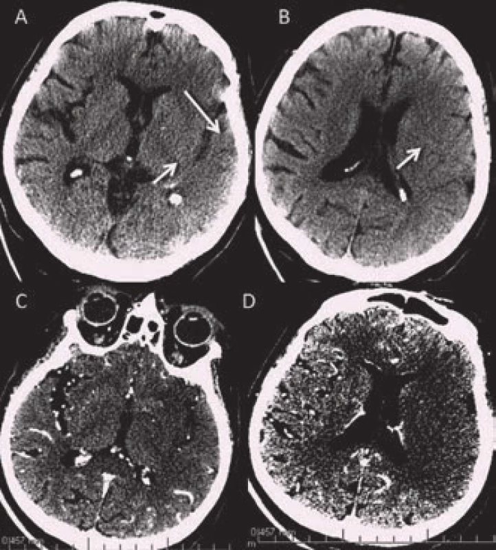 Časné známky ischemie na nativním CT (A, B) a výpadek perfuze na zdrojových scanech CT angiografie („CTA perfuze“) (C, D).
