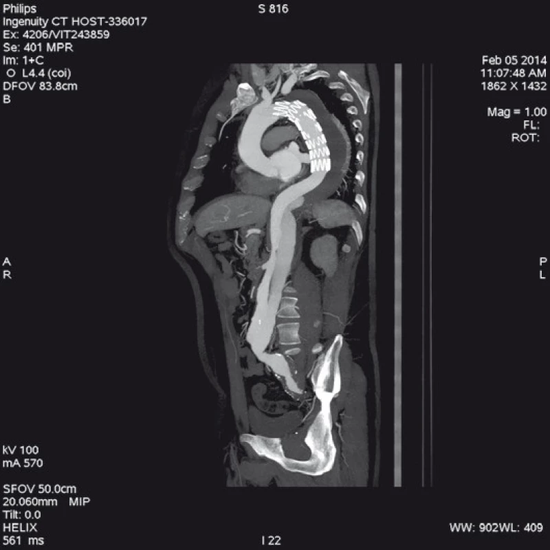 Stejný pacient jako na obr. 3; 18. měsíců po implantaci hrudního stentgraftu s překrytím primární trhliny. Kontrolní CT angiografie zobrazuje plně rozepnutý stentgraft s trombózou false lumen v oblasti sestupné hrudní aorty. Z důvodu reentry v oblasti mezenterické a levé renální tepny se plní falešný kanál v oblasti břišní aorty a levé společné ilické tepny.