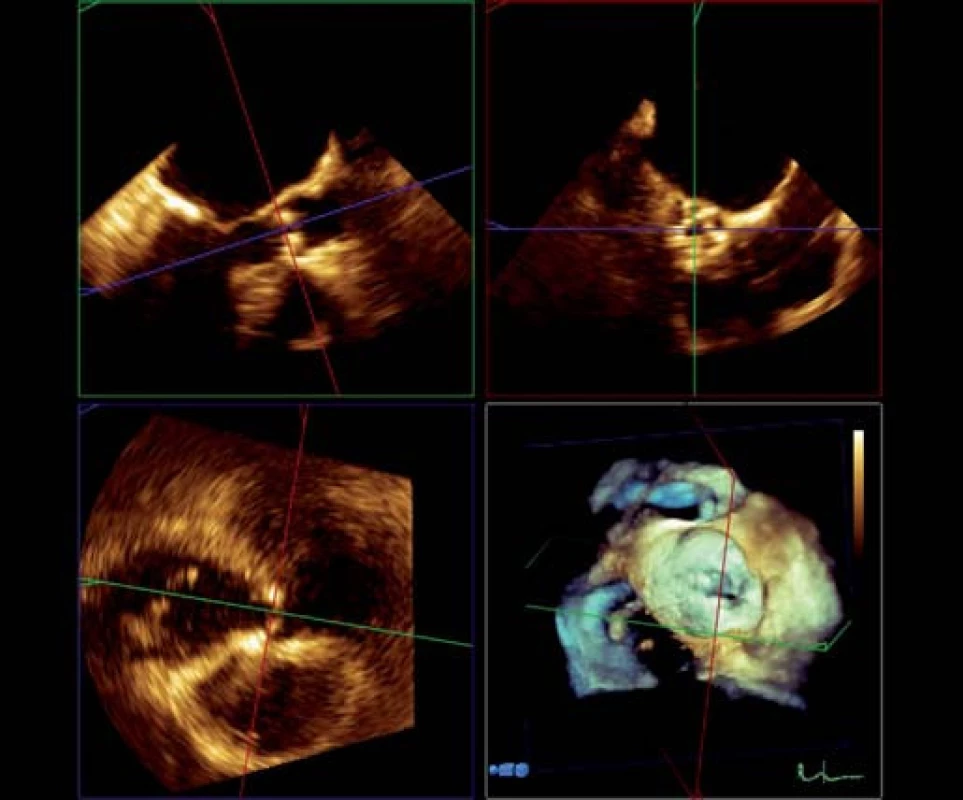 RT 3D TEE aortální chlopně, multiplanární rekonstrukce.