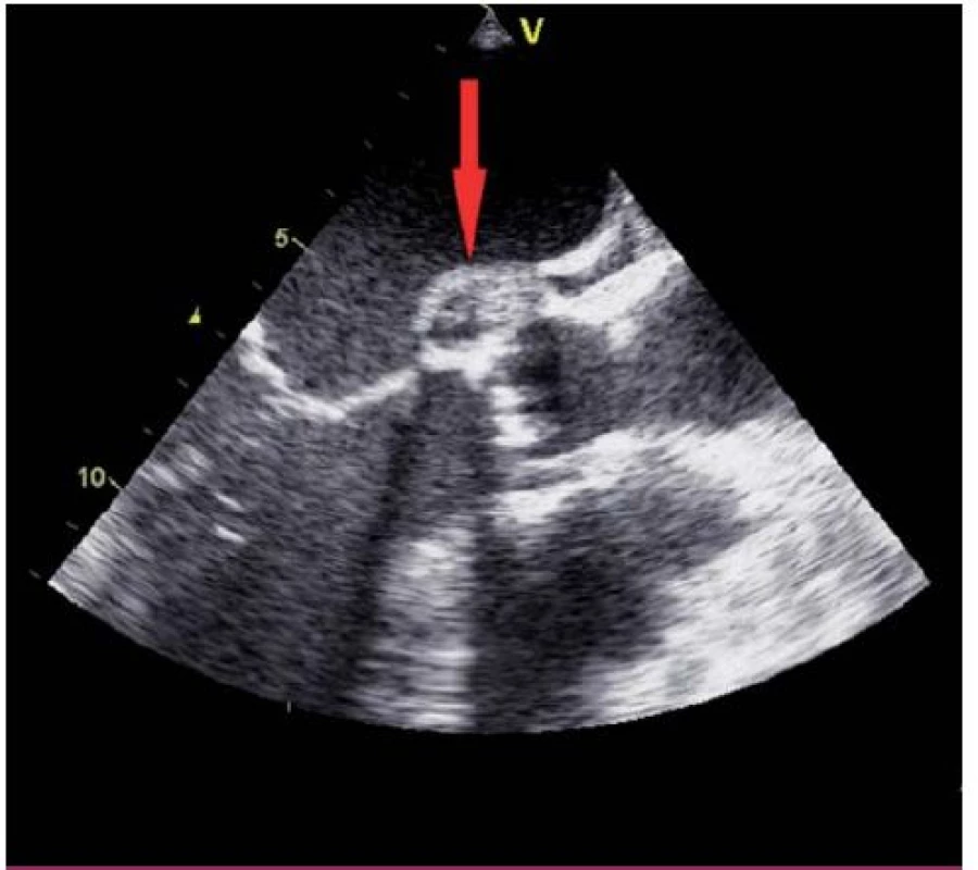 Paravalvulární absces při aortální chlopni (transezofageální echokardiografie – projekce na dlouhou osu levé komory).