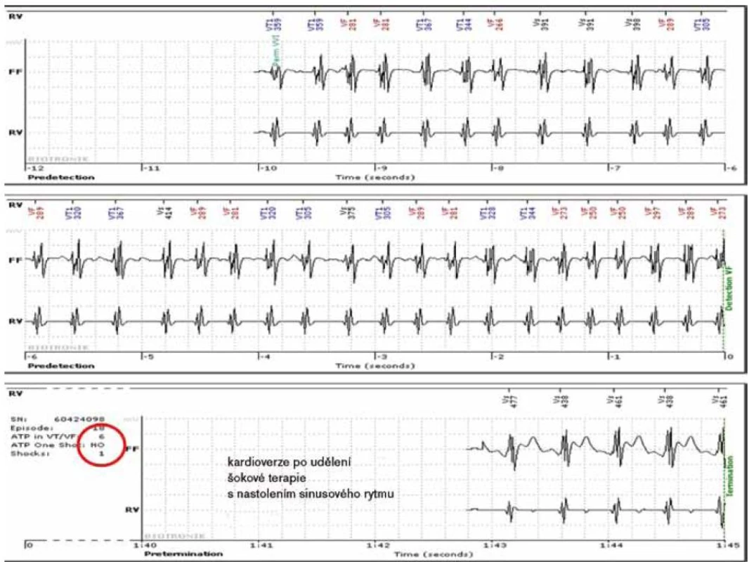 Záznam intrakardiálního EKG z tachykardické epizody při fibrilaci síní s velmi rychlou komorovou odpovědí vyhodnocené nesprávně ICD přístrojem jako komorová tachykardie a neadekvátně poté intervenované 6ATP a 1 šokem, po kterém dochází ke kardioverzi na sinusový rytmus.
