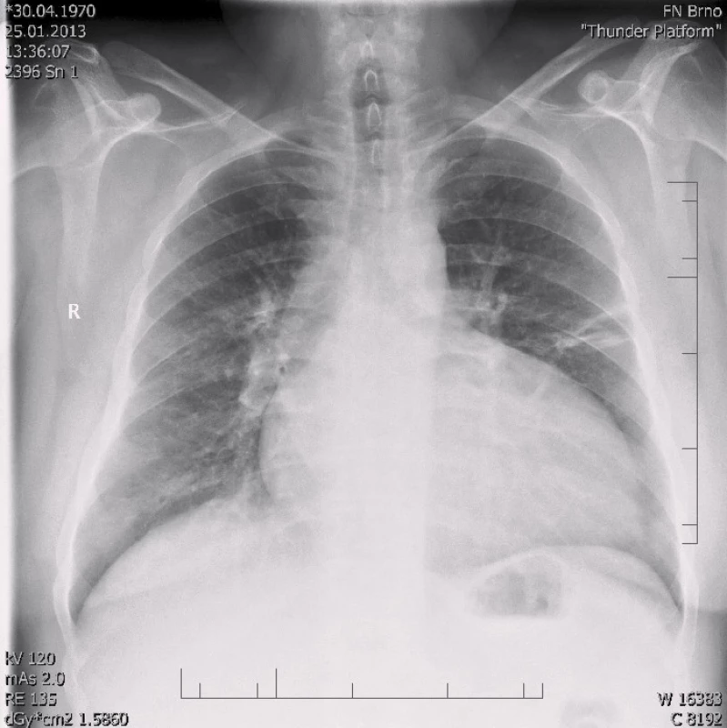 RTG snímek s dilatací srdečního stínu oběma směry s predilekcí doleva, kardiothorakální index 0,61 při přijetí v roce 2013.