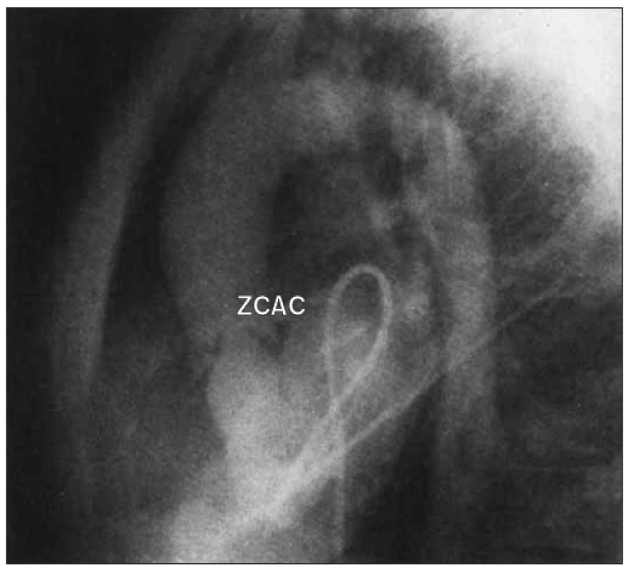 Komorový angiogram v laterálním pohledu u aortální stenózy ukazuje ztluštělou kopulovitou chlopeň a poststenotickou dilataci aorty.