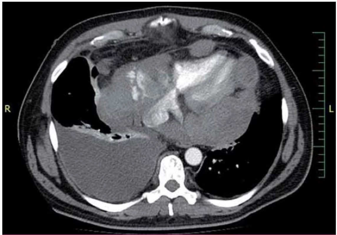 CT hrudníku (11/2013) – rozsáhlé tumorózní hmoty v oblasti perikardu.