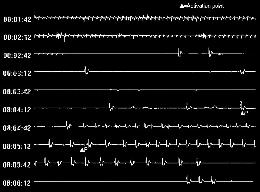 Příklad EKG-záznamu arytmické epizody (muž, 21 let, palpitace, presynkopy, supraventrikulární tachykardie typu AVNRT, následně řešená RF-ablací).