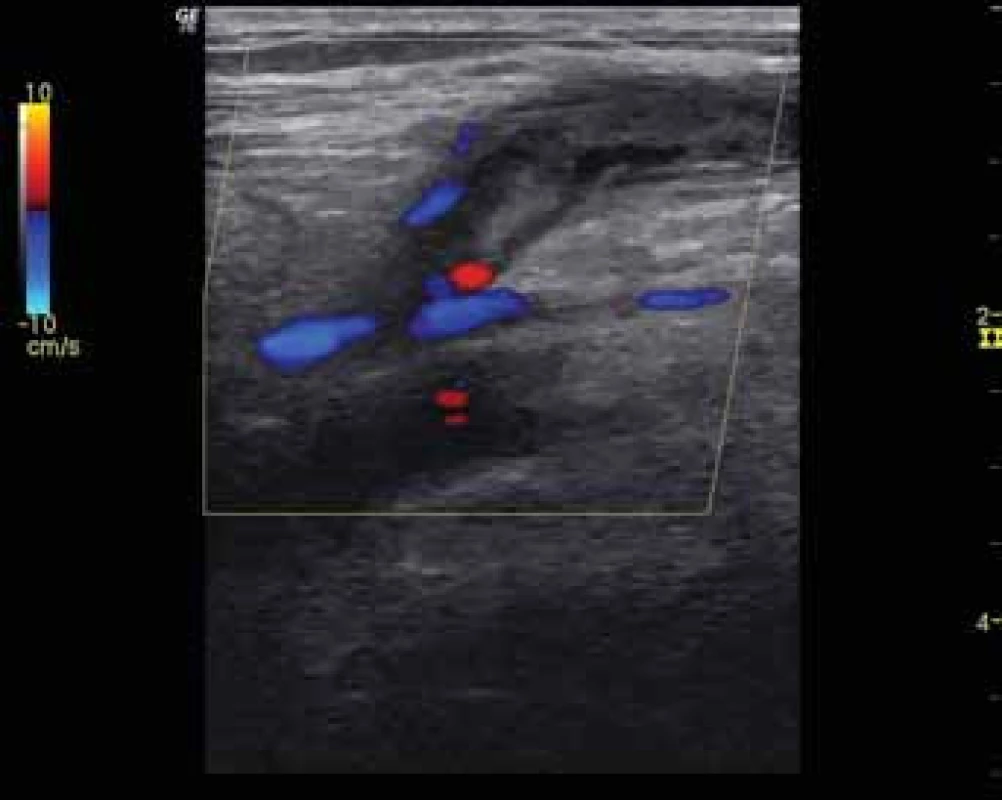 Ultrazvukový průkaz patofyziologie – potrombotická echogenní částečná obstrukce lumen malé safény těsně před jejím vyústěním do podkolenní žíly (vlevo B-mód, vpravo barevné mapování krevního toku).
