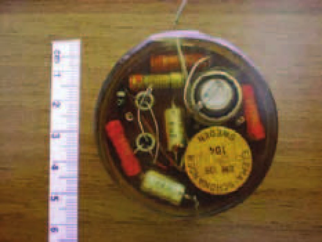 První dlouhodobě fungující kardiostimulátor byl implantován 3. února 1960 v Uruguayi. Jednalo se o upravený Senningův model. Pacientka přežila 9 měsíců a zemřela na infekční komplikaci.