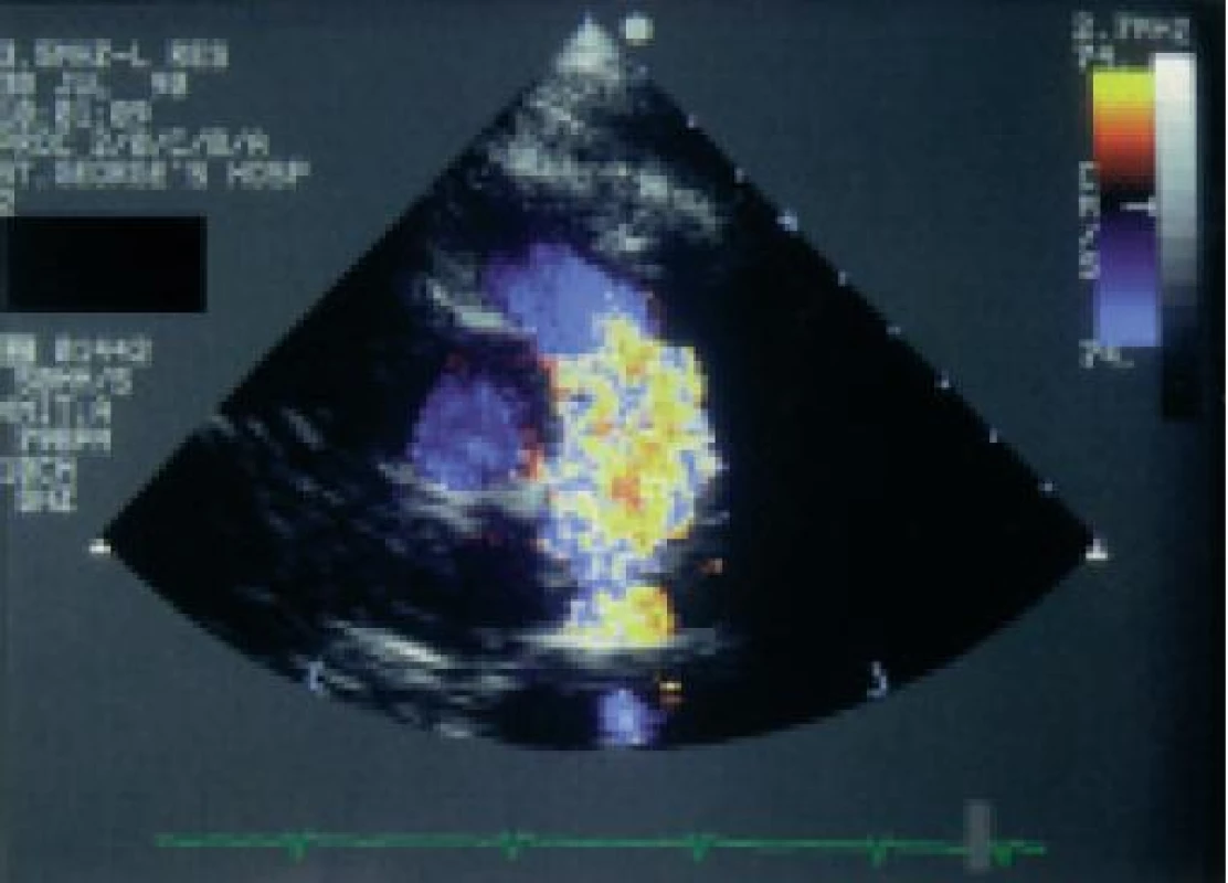2D-parasternální pohled v krátké ose barevným dopplerovským vyšetřením ukazuje turbulentní tok distálně od chlopně plicnice u dítěte s lehkou stenózou plicnice.