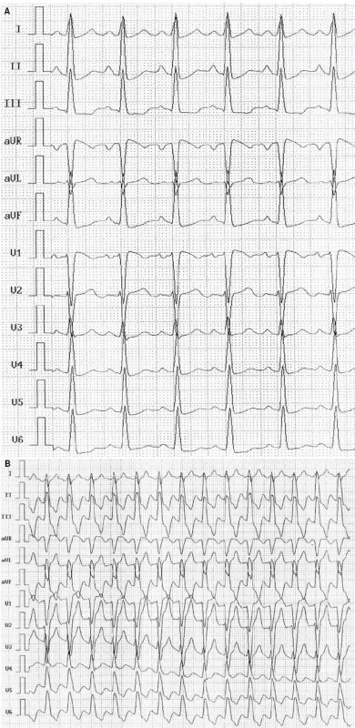 Záznam EKG před bicyklovou ergometrií (A) a po ní (B) (12/1999) – blok levého raménka Tawarova.