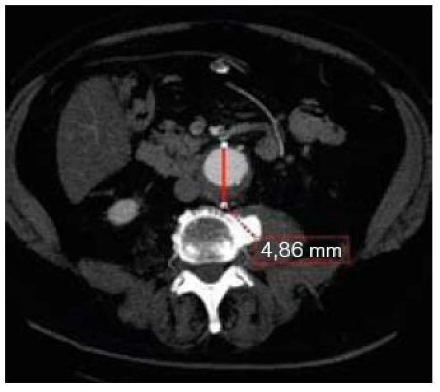 CT transverzální řez v úrovni max. průměru vaku aneuryzmatu břišní aorty.