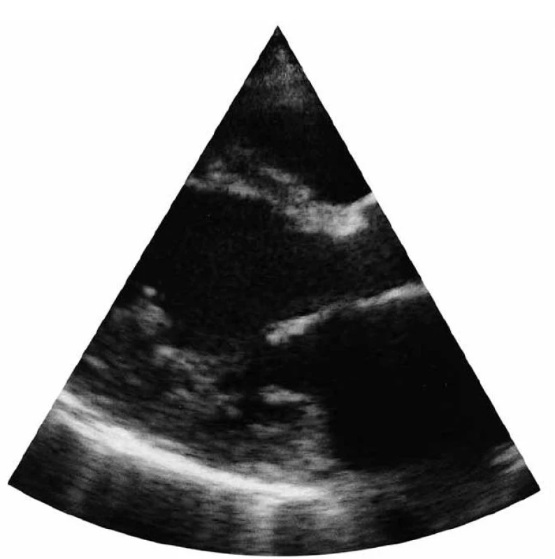 Transtorakální echokardiografie (11/2005) – parasternální projekce 2-DE na levou komoru srdeční.