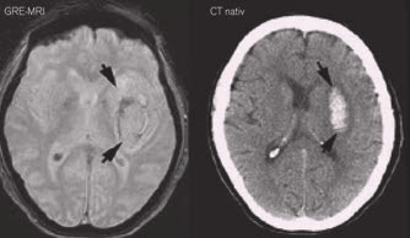 Akutní intracerebrální hematom na MRI ve srovnání s CT.