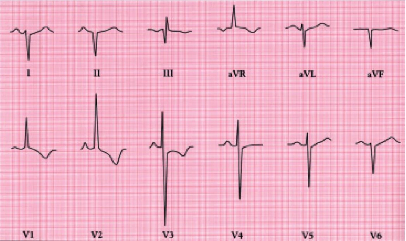 EKG u těžké stenóz plicnice ukazuje hluboký kmit S ve svodu I, vysoký kmit R ve V1,2 a inverze vln T v pravých hrudních svodech.