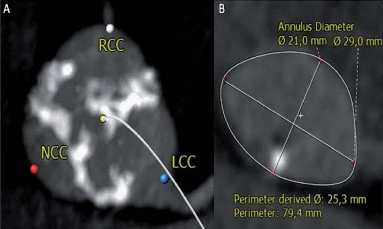 Trojcípá aortální chlopeň je symetrická v úrovni cípů (A), ale aortální anulus je výrazně eliptický (B) s velikostí (perimetr/π) 25 mm. Měření aortálního anulu pomocí jícnové echokardiografie typicky hodnotí kratší osu, v tomto případě bylo změřeno 21 mm.
