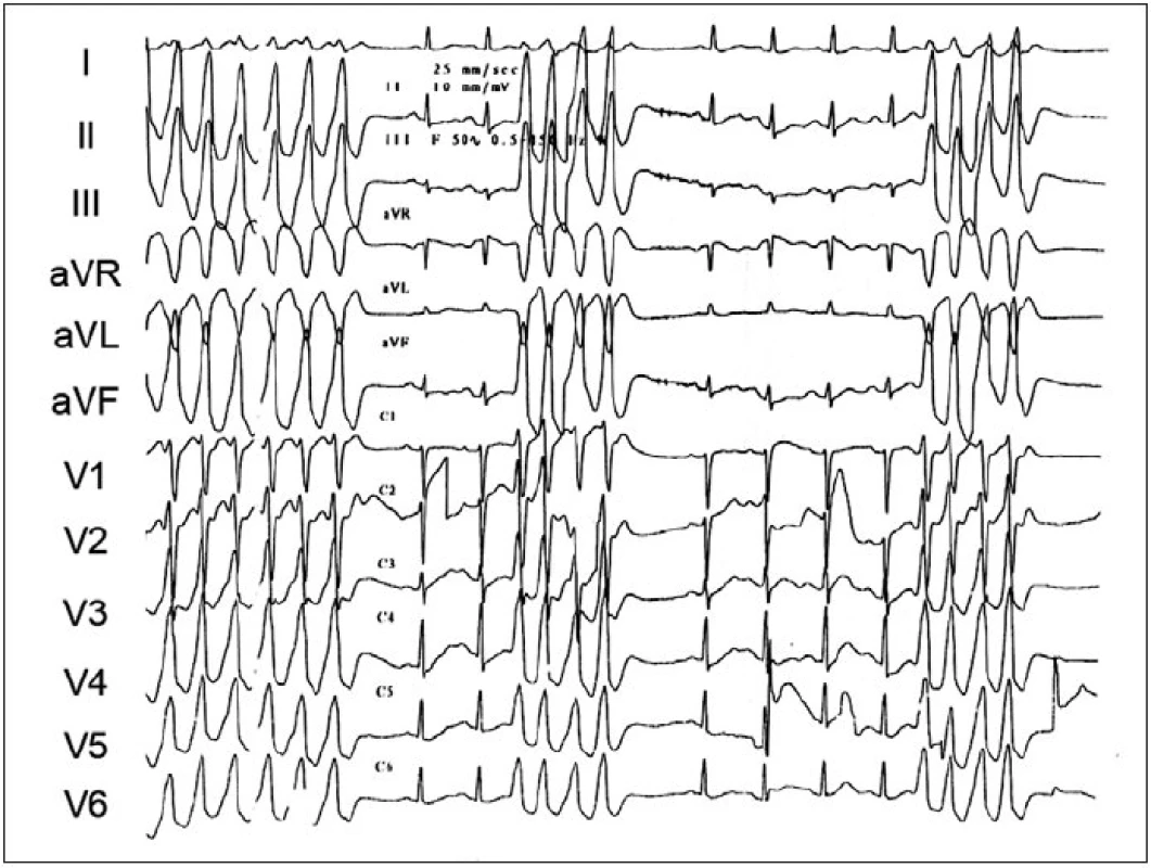 Ukázka repetitivních běhů idiopatické KT. V EKG-obrazu je patrna přechodní zóna ve V&lt;sub&gt;2&lt;/sub&gt; s úplnou pozitivitou QRS ve svodu V&lt;sub&gt;3&lt;/sub&gt;. Arytmie pocházela z fokusu přístupného z kapsičky pulmonální chlopně.
